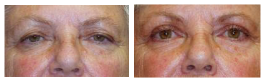 Before and after for removal of the excess upper lid skin at wake plastic surgery in cary nc
