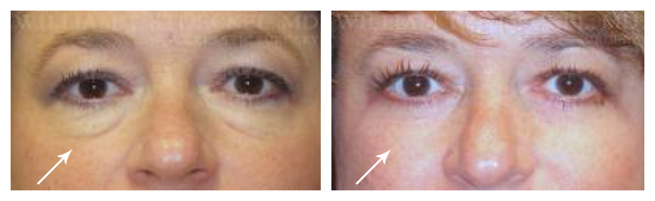 blepharoplasty before and after at wake plastic surgery in cary nc