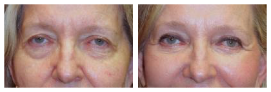 Before and after of a complete eyelid makeover at wake plastic surgery in cary nc