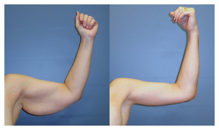 Complete tightening of the loose arm skin with full brachioplasty at wake plastic surgery cary nc