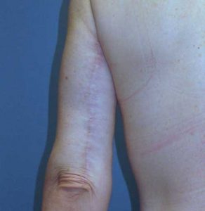 Posterior arm scar 6 months after surgery at wake plastic surgery cary nc