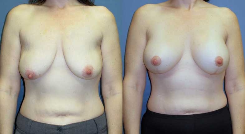 breast lift before and after at wake plastic surgery cary nc
