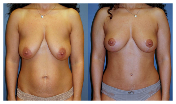 breast lift before and after at wake plastic surgery cary nc