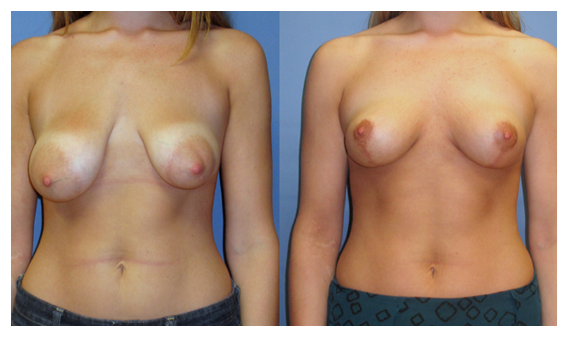breast lift before and after at wake plastic surgery cary nc