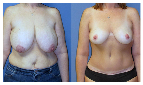 breast reduction before and after at wake plastic surgery cary nc