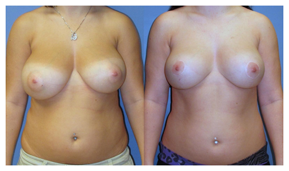 breast reduction before and after at wake plastic surgery cary nc