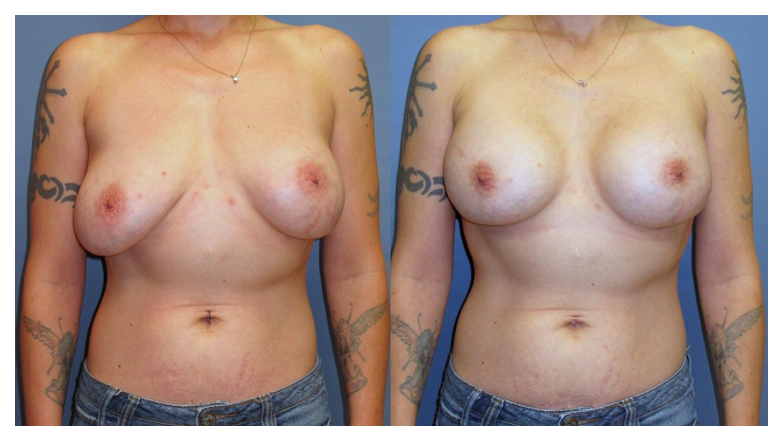 breast revision before and after at wake plastic surgery cary nc