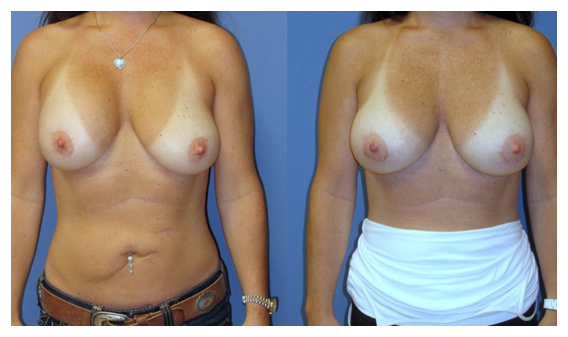 breast revision before and after at wake plastic surgery cary nc