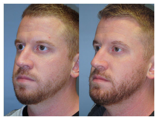 Before and after of Chin implant at wake plastic surgery in cary nc