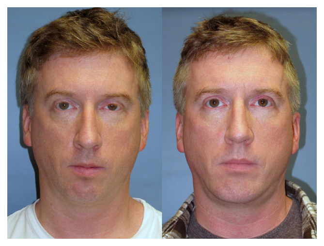 Before and after of Chin implant at wake plastic surgery in cary nc
