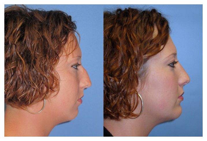 chin implant before and after at wake plastic surgery in cary nc