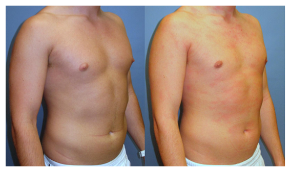 gynecomastia before and after at wake plastic surgery cary nc