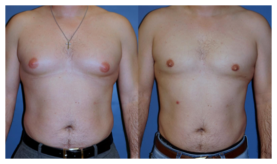 gynecomastia before and after at wake plastic surgery cary nc