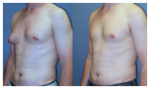 gynecomastia before and after at wake plastic surgery cary nc