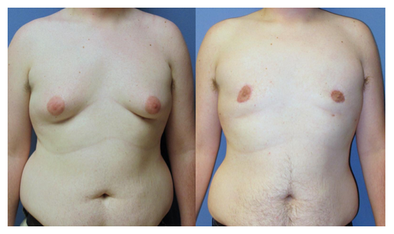 gynecomastia before and after at wake plastic surgery cary nc