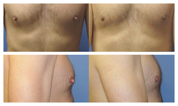 nipple reduction before and after at wake plastic surgery cary nc