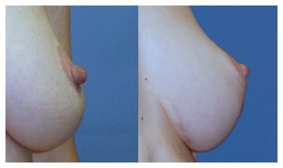 nipple reduction before and after at wake plastic surgery cary nc