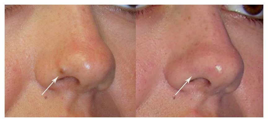 non cancer lesion before and after at wake plastic surgery in cary nc