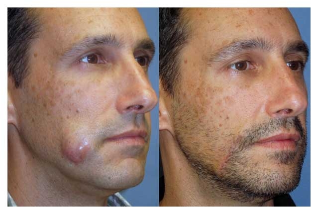 non cancer lesion before and after at wake plastic surgery in cary nc