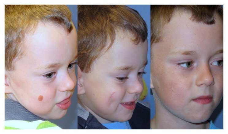 non cancer lesion before and after at wake plastic surgery in cary nc