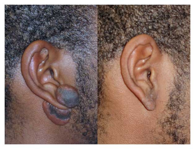 non cancer lesion before and after at wake plastic surgery in cary nc