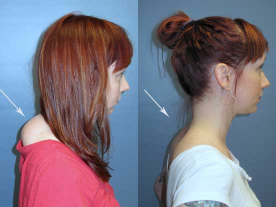 non cancer lesion before and after at wake plastic surgery in cary nc
