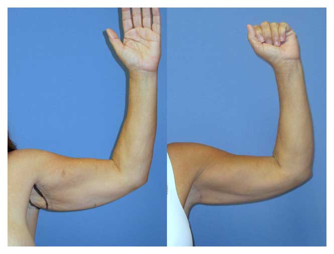 Short scar brachioplasty at wake plastic surgery cary nc
