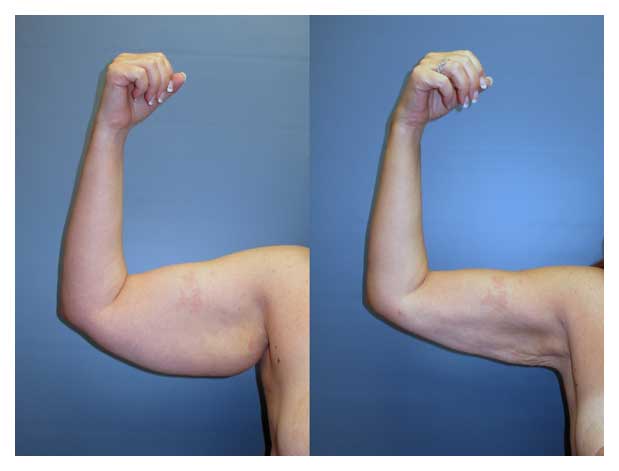 Arm liposuction at wake plastic surgery cary nc