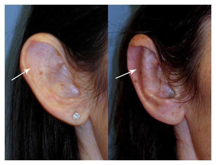 Before and after photo of ear surgery at wake plastic surgery cary nc