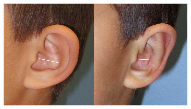 Before and after photo of ear surgery at wake plastic surgery cary nc