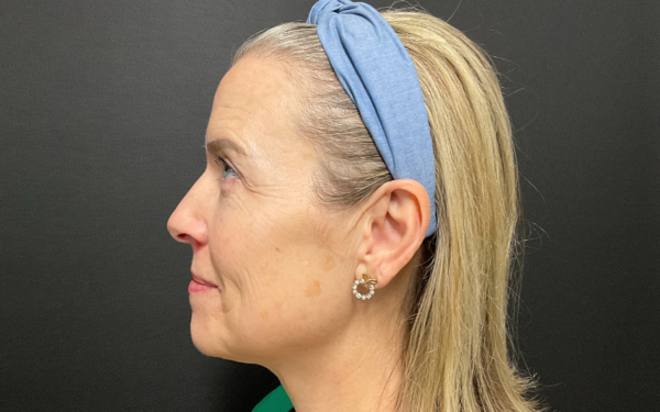Patient-6 | Before Laser Services