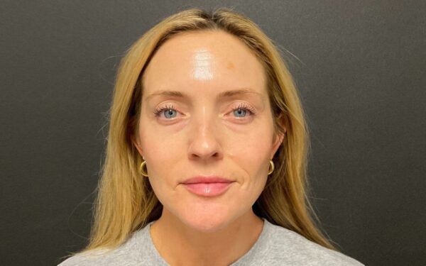 Patient-5 | Before Laser Services