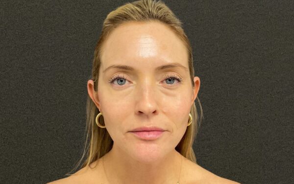 Patient-5 | After Laser Services