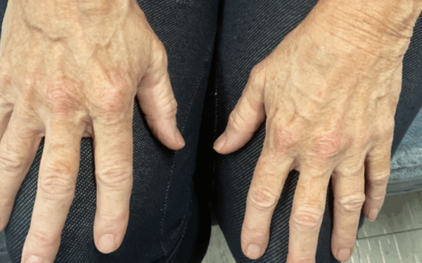 Patient-2 | After Laser Services