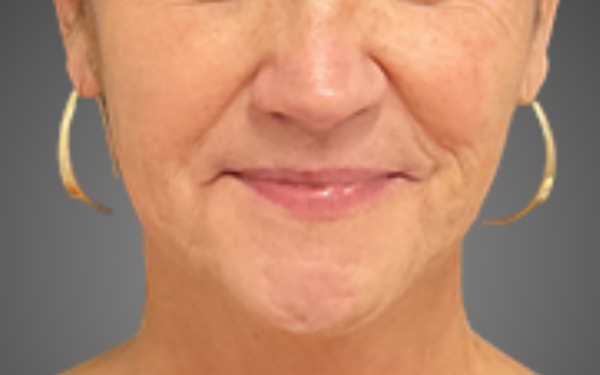Patient-3 | After Laser Services