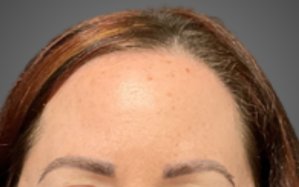 BBL-Patient-4 | Before Laser Services