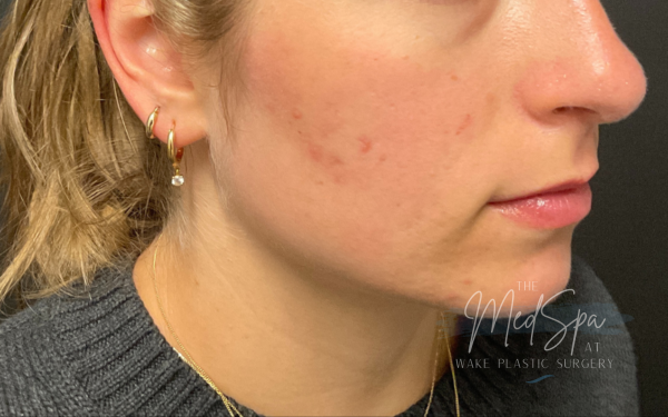 BBL-Patient-1 | Before Laser Services