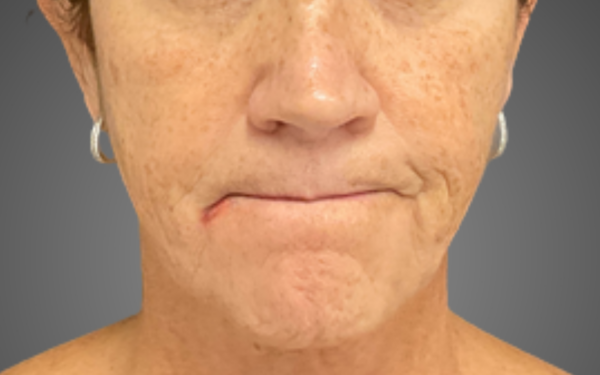 Patient-3 | Before Laser Services