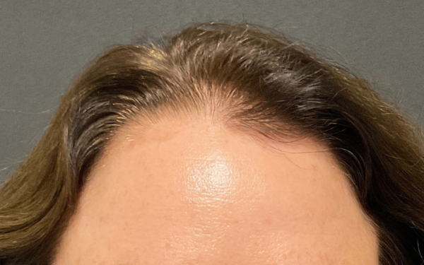 Halo-Patient-9 | After Laser Services