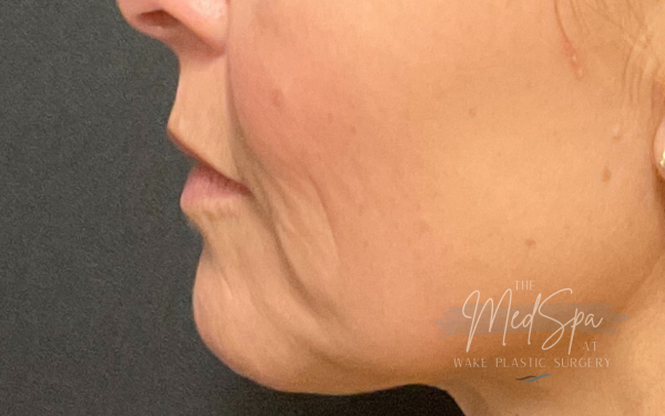 Halo-Patient-2 | Before Laser Services