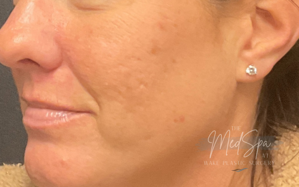 Halo-Patient-4 | Before Laser Services