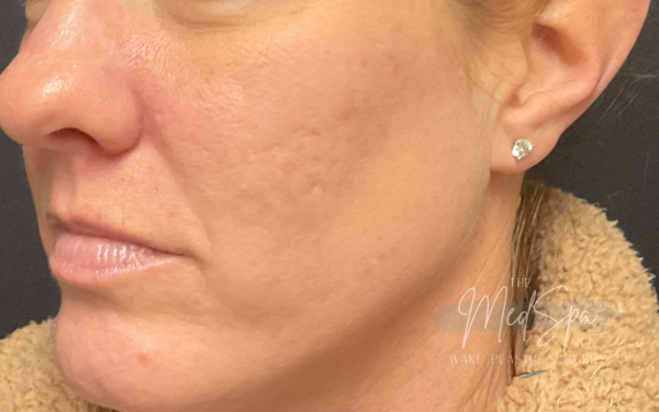 Halo-Patient-4 | After Laser Services