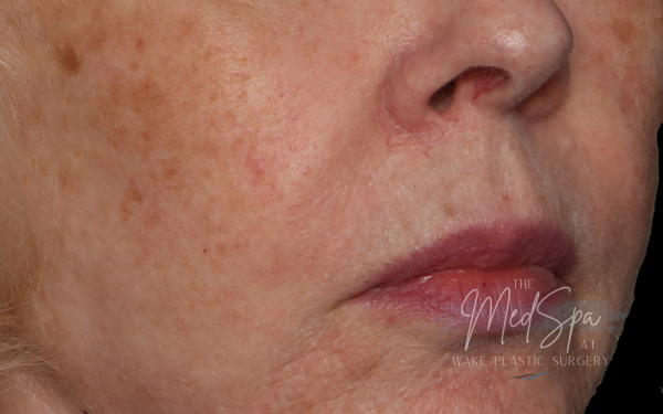 HALO Laser before picture
