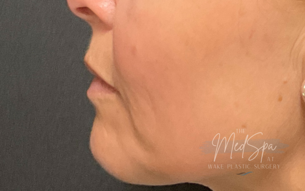 Halo-Patient-2 | After Laser Services