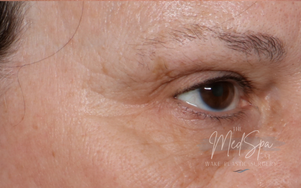 Halo-Patient-5 | After Laser Services