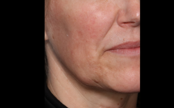 Halo-Patient-6 | Before Laser Services