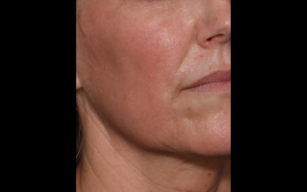 Halo-Patient-6 | After Laser Services