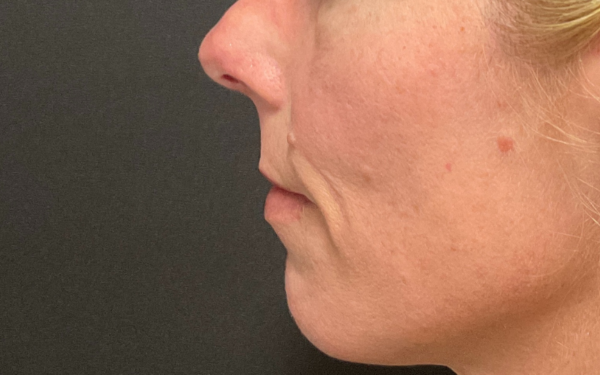 Halo-Patient-7 | Before Laser Services