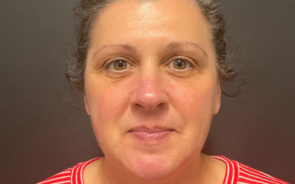 Halo-Patient-8 | Before Laser Services
