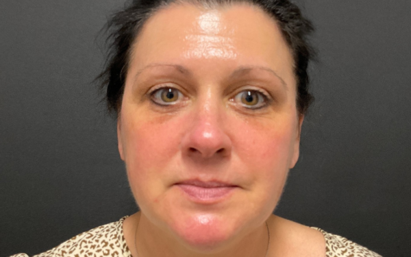 Halo-Patient-8 | After Laser Services